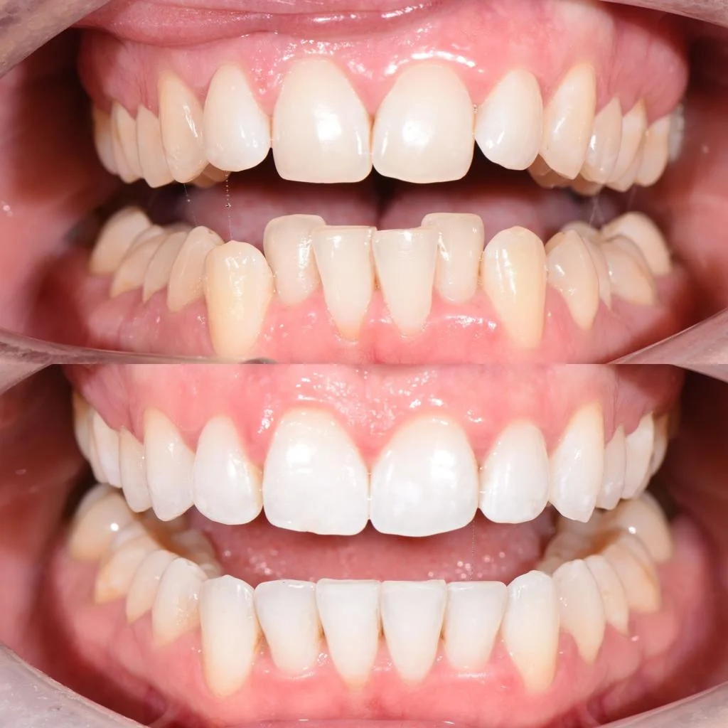 invisalign-5