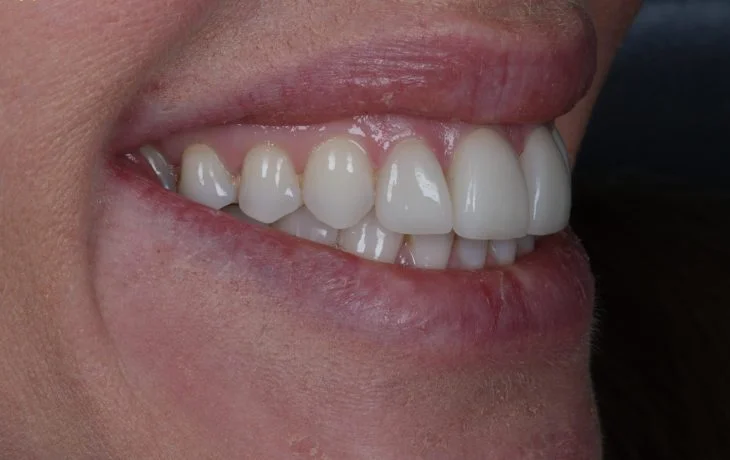 Right-side-smile-After