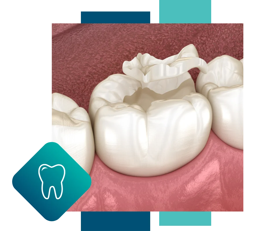 inlays-and-onlays-hero